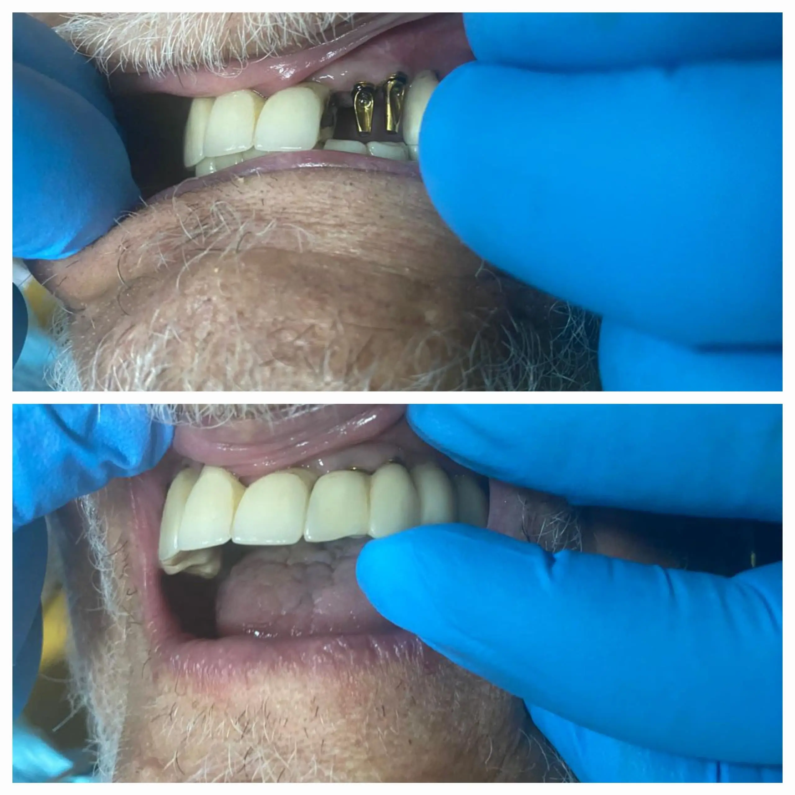 Implant Bridge done at Sterling Dental Clinic